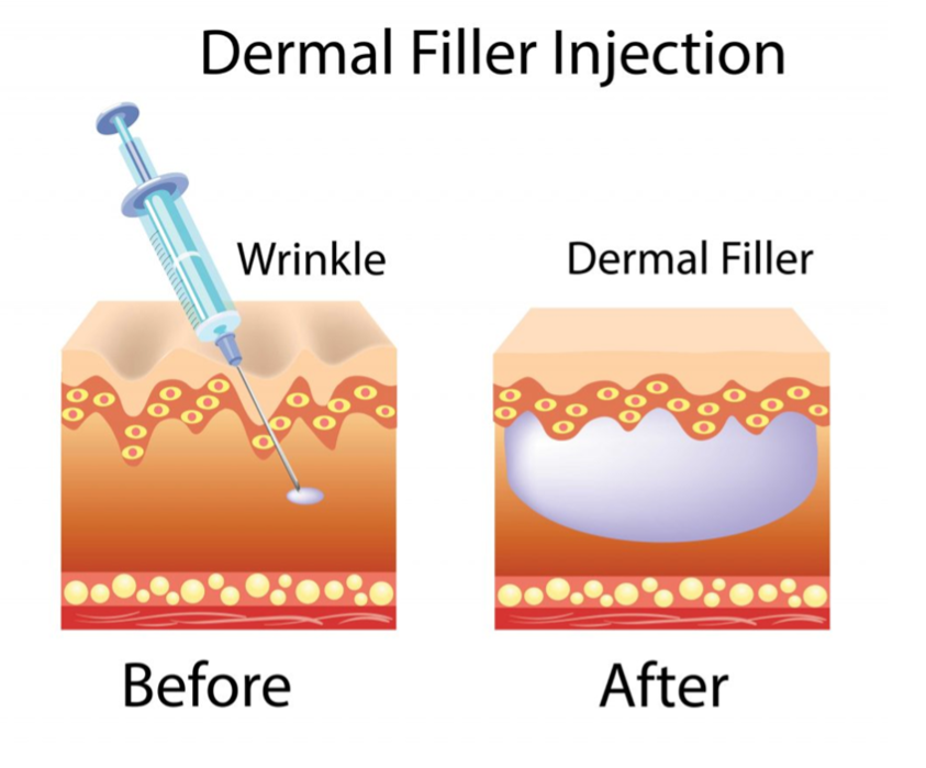 Dermal-Fillers